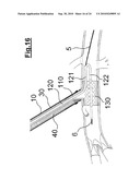 DEVICE FOR IMPLANTING A VASCULAR PROSTHESIS diagram and image