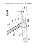 DEVICE FOR IMPLANTING A VASCULAR PROSTHESIS diagram and image