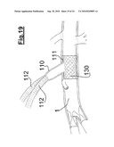 DEVICE FOR IMPLANTING A VASCULAR PROSTHESIS diagram and image