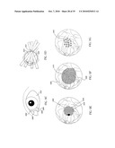 ORTHOVOLTAGE RADIOTHERAPY diagram and image