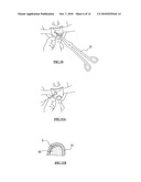 BIORESORBABLE INFLATABLE DEVICES, INCISION TOOL AND METHODS FOR TISSUE EXPANSION AND TISSUE REGENERATION diagram and image