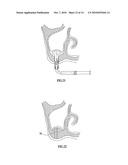 BIORESORBABLE INFLATABLE DEVICES, INCISION TOOL AND METHODS FOR TISSUE EXPANSION AND TISSUE REGENERATION diagram and image