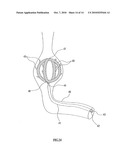 BIORESORBABLE INFLATABLE DEVICES, INCISION TOOL AND METHODS FOR TISSUE EXPANSION AND TISSUE REGENERATION diagram and image