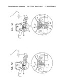 Implants, tools, and methods for sinus lift and bone augmentation diagram and image