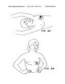 FLEXIBLE AND/OR ELASTIC BRACHYTHERAPY SEED OR STRAND diagram and image