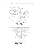 VIDEO LARYNGOSCOPE SYSTEM AND DEVICES diagram and image