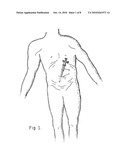 SKIN SEAL WITH INFLATABLE MEMBRANE diagram and image