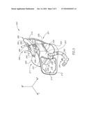 ENDOSCOPIC BITE BLOCK diagram and image