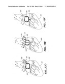 ARTICULATING CATHETERS diagram and image