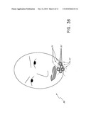 Methods for Identifying Areas of a Subject s Skin that Appear to Lack Volume diagram and image