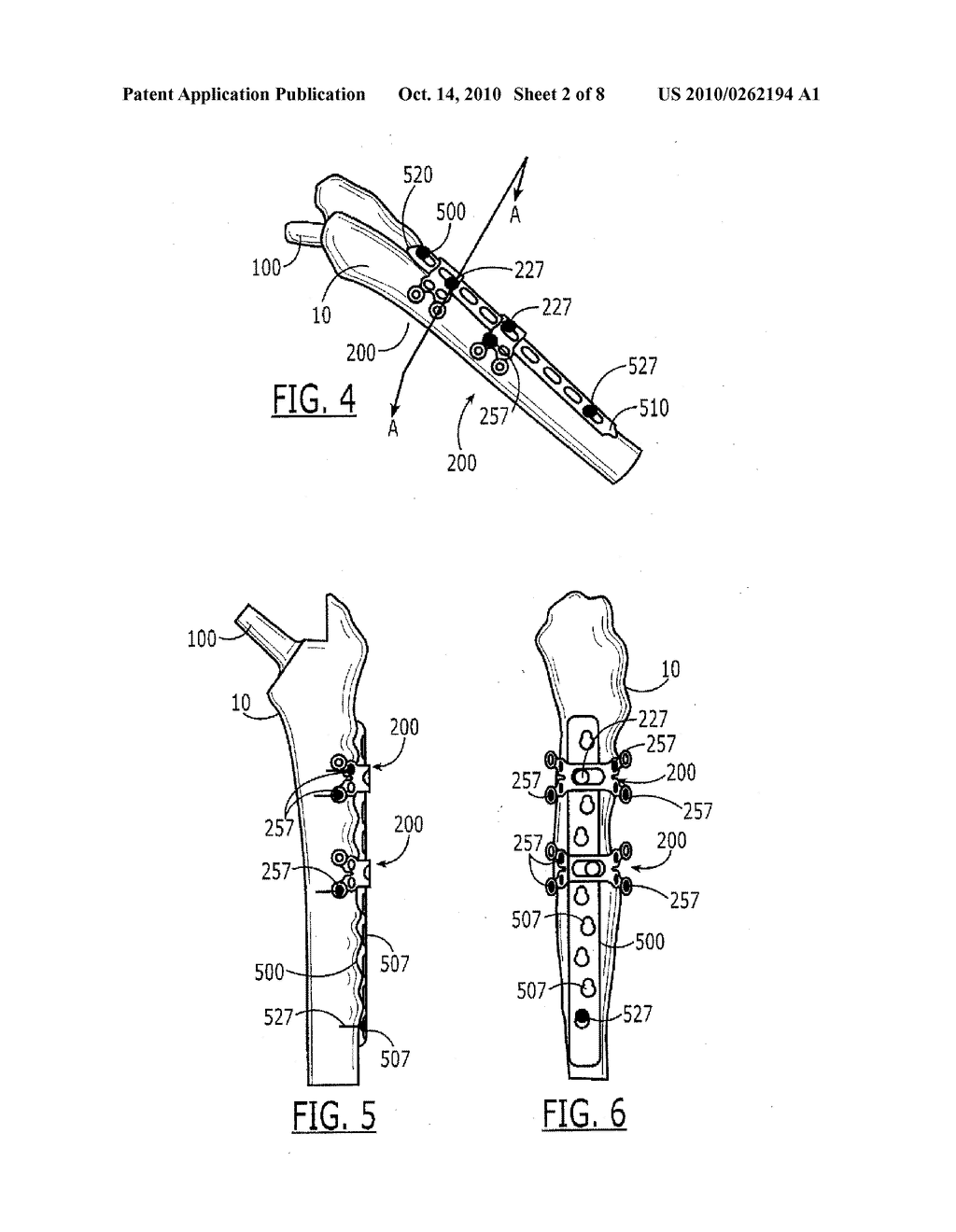 Periprosthetic Fracture Repair - diagram, schematic, and image 03