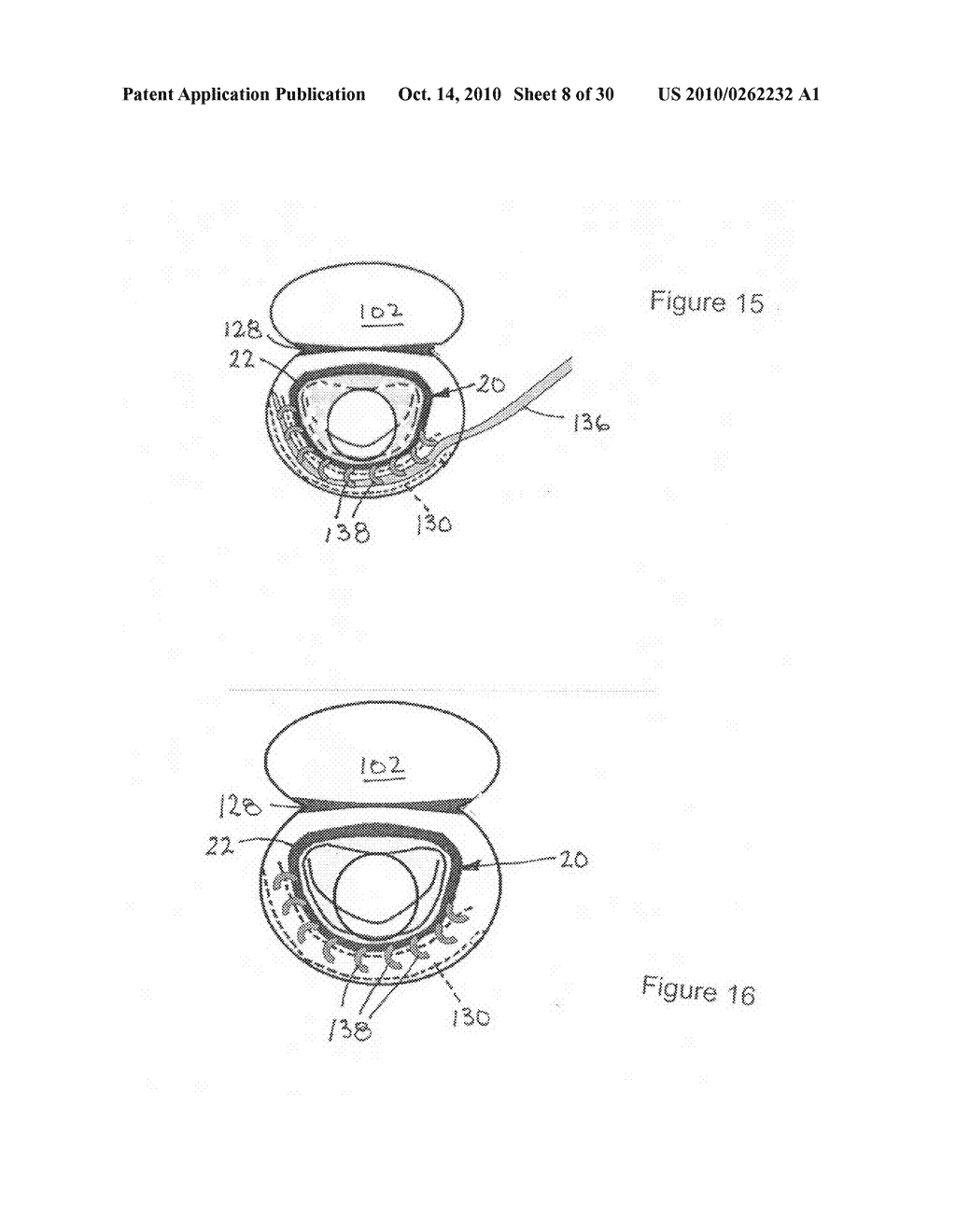 Implantable scaffolding containing an orifice for use with a prosthetic or bio-prosthetic valve - diagram, schematic, and image 09