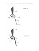 Implantable scaffolding containing an orifice for use with a prosthetic or bio-prosthetic valve diagram and image
