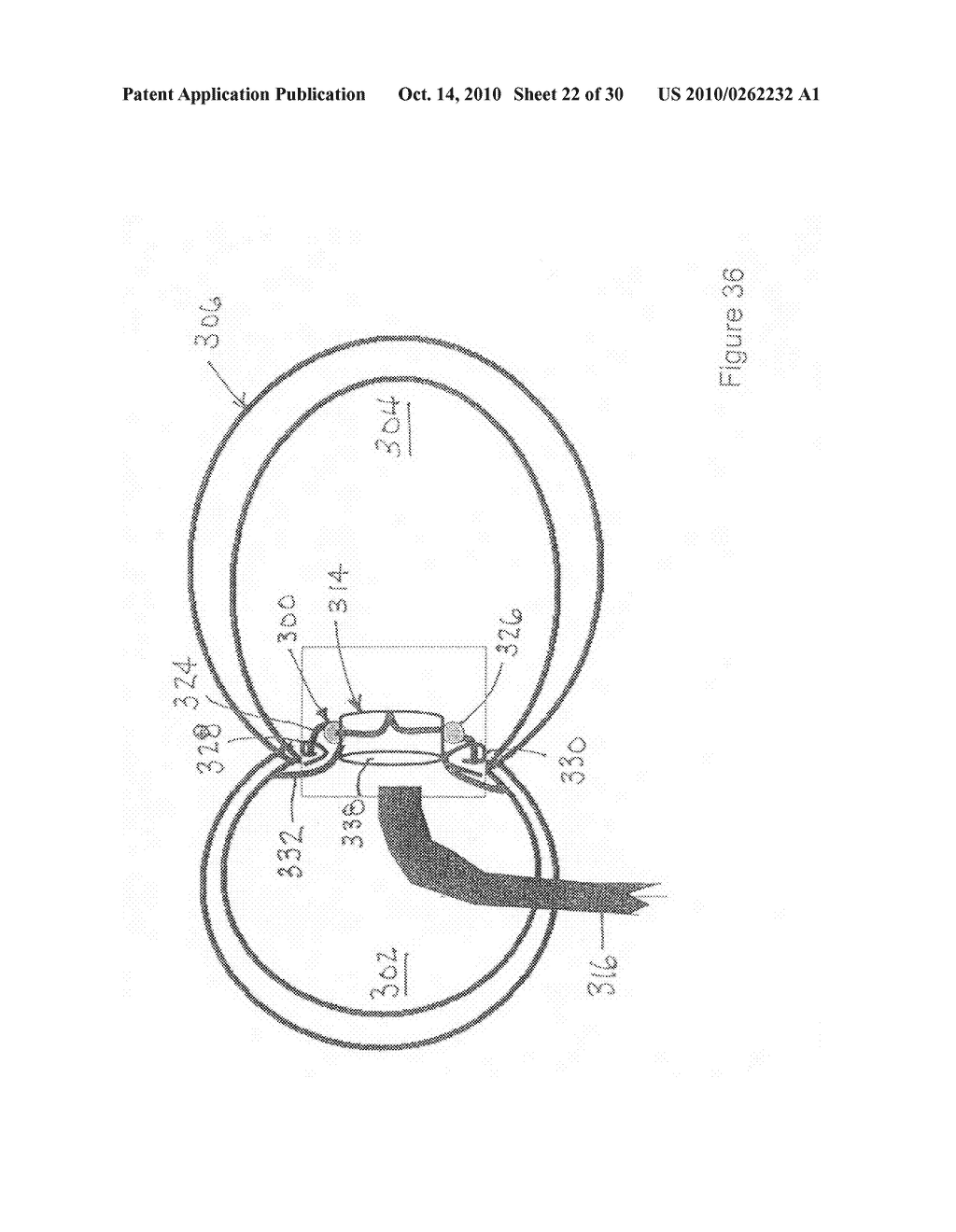 Implantable scaffolding containing an orifice for use with a prosthetic or bio-prosthetic valve - diagram, schematic, and image 23