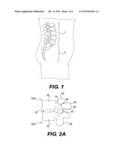 Prosthesis and Method for Replacing Degenerative Vertebral Portions diagram and image