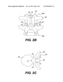 Prosthesis and Method for Replacing Degenerative Vertebral Portions diagram and image