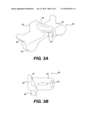 Prosthesis and Method for Replacing Degenerative Vertebral Portions diagram and image