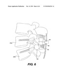 Prosthesis and Method for Replacing Degenerative Vertebral Portions diagram and image