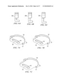 Oral Appliance for Treating a Breathing Condition diagram and image