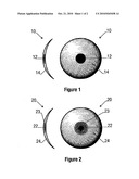 CONTACT LENS FOR TREATING BINOCULAR DIPLOPIA diagram and image