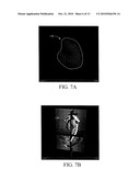 SYSTEM FOR QUANTIFICATION OF NEOVASCULATURE IN CT VOLUMES diagram and image