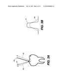 DENTAL SURFACE IMAGING USING POLARIZED FRINGE PROJECTION diagram and image