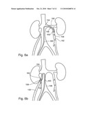 METHODS AND APPARATUSES FOR VASCULAR AND PROSTATE TREATMENT diagram and image