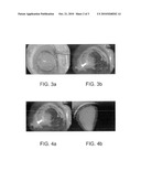 SHIELDED INTRAOCULAR PROBE FOR IMPROVED ILLUMINATION OR THERAPEUTIC APPLICATION OF LIGHT diagram and image