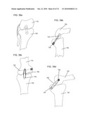 DELIVERY SYSTEMS, TOOLS, AND METHODS OF USE diagram and image