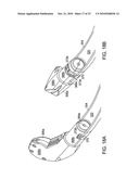 SUTURE PASSER diagram and image