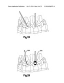 CLAMPS USED FOR INTERCONNECTING A BONE ANCHOR TO A ROD diagram and image