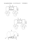 Minimally Invasive Expandable Contained Vertebral Implant and Method diagram and image