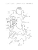 Minimally Invasive Expandable Contained Vertebral Implant and Method diagram and image