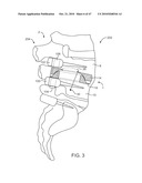 Posterior Spinal Device and Method diagram and image