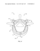 Posterior Spinal Device and Method diagram and image