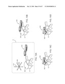 Posterior Spinal Device and Method diagram and image