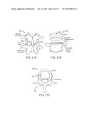 Posterior Spinal Device and Method diagram and image