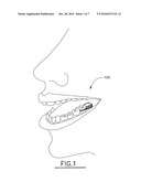 Method and intra-oral device for smoking cessation or alcohol cessation diagram and image