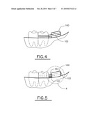 Method and intra-oral device for smoking cessation or alcohol cessation diagram and image