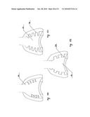 STEADY PRESSURE DENTAL IMPRESSION TRAY AND THE IDEA OF OPERATION diagram and image