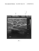 ULTRASONOGRAPHIC IDENTIFICATION OF A SENTINEL LYMPH NODE diagram and image