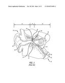 Method and System for Treating Target Tissue Within the Eustachian Tube diagram and image