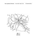 Method and System for Treating Target Tissue Within the Eustachian Tube diagram and image