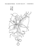 Method and System for Treating Target Tissue Within the Eustachian Tube diagram and image