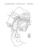 Method and System for Treating Target Tissue Within the Eustachian Tube diagram and image