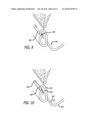 Method and System for Treating Target Tissue Within the Eustachian Tube diagram and image