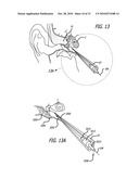 Method and System for Treating Target Tissue Within the Eustachian Tube diagram and image