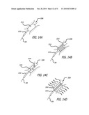 Method and System for Treating Target Tissue Within the Eustachian Tube diagram and image