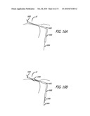 Method and System for Treating Target Tissue Within the Eustachian Tube diagram and image