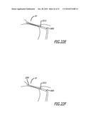 Method and System for Treating Target Tissue Within the Eustachian Tube diagram and image